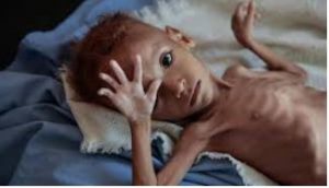 98 Children are suffering mal nutrition in Bairru Pite Clinic